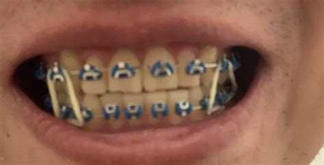 fastbraces reddit|5 months progress on fastbrace : r/braces .